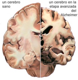 cerebro con alzheimer