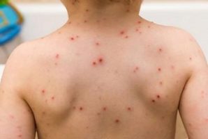 En RD reportan más de tres mil casos de varicela; uno de los brotes más altos en cinco años